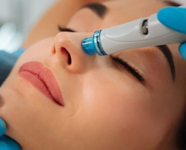AcneAnce Scar Treatment (1)
