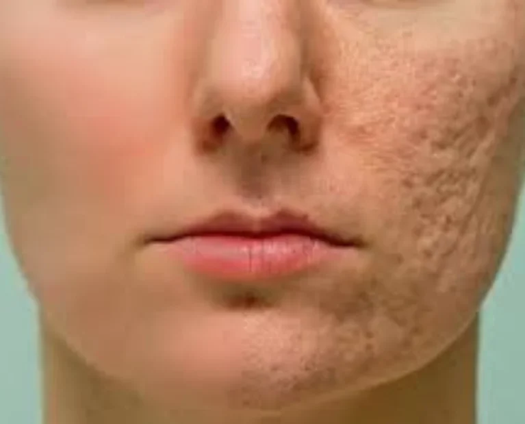 AcneAnce Scar Treatment