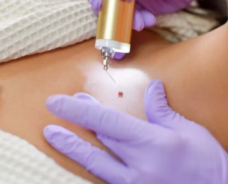 Moles & Warts Removal