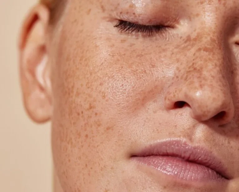 Pigmentation Treatment