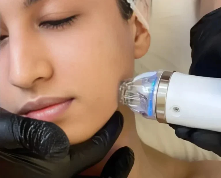 RF Microneedling