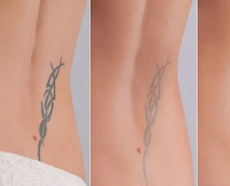 Tattoo Removal